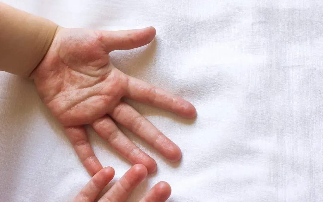 How Long Will My Kid Have Hand, Foot, and Mouth Disease?