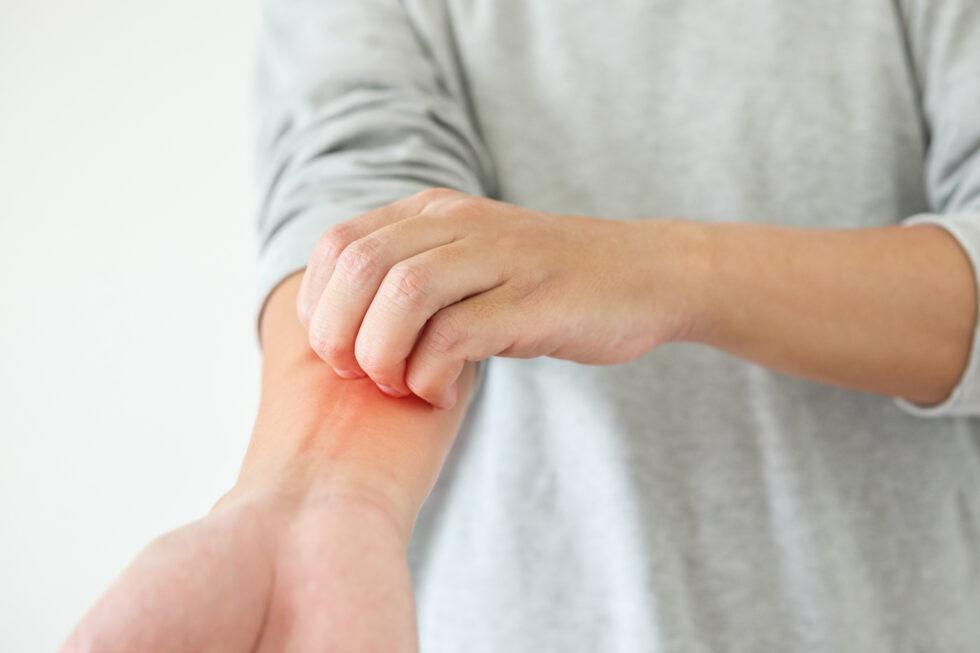 Tips for Managing Dry Skin and Avoiding Irritation