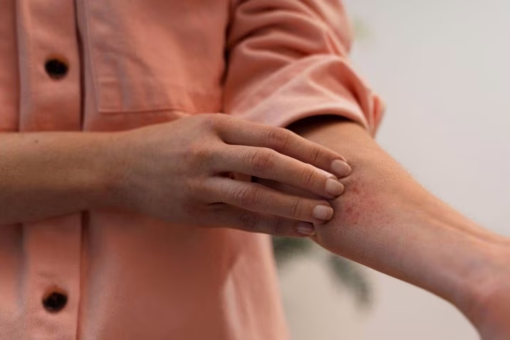 Fast Relief for Rashes in Bloomfield, NJ | AFC Urgent Care