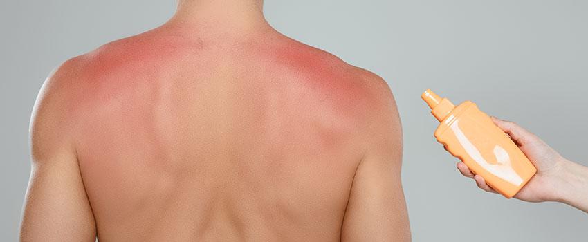 How Can I Avoid Getting Sunburned This Year? How Can I Avoid Getting Sunburned This Year?