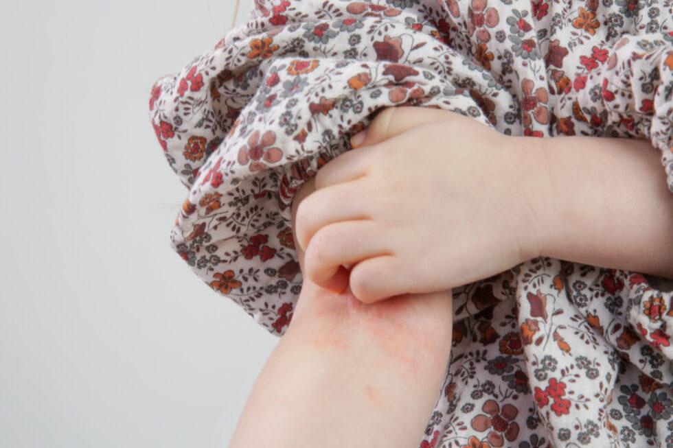 Identifying Poison Ivy on Kids