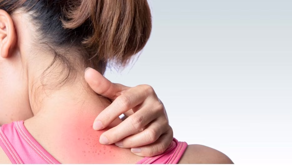 Sunburn Symptoms, Prevention Tips, and Best Treatment Options