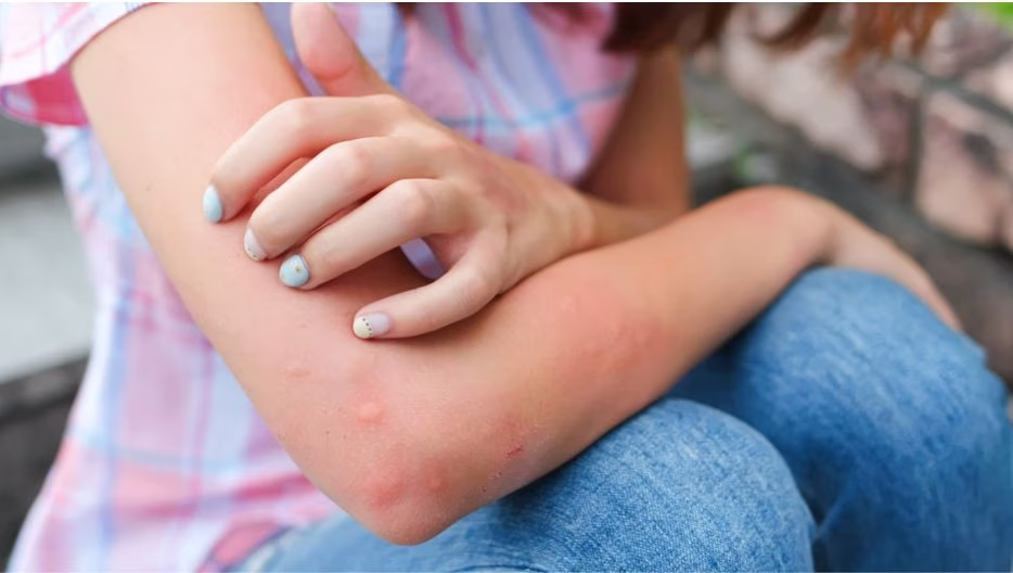 Insect Bite or Sting Symptoms and Treatment Options for Quick Relief
