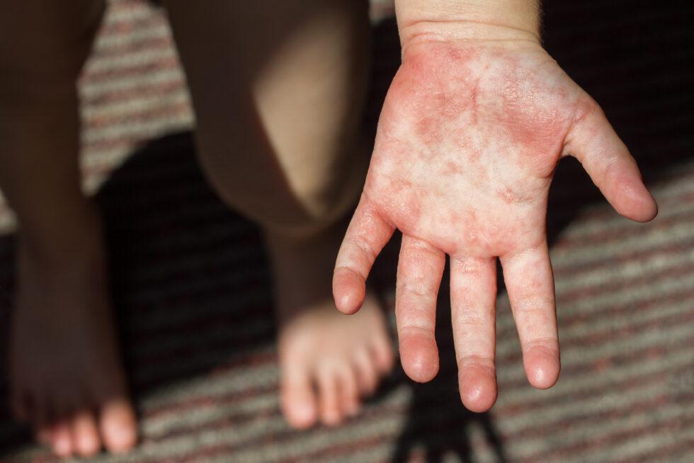 Measles: What Causes it and Can I Still Get Measles if I am Vaccinated?
