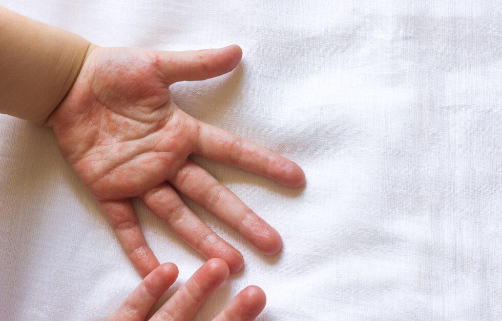 Measles Vaccine & Immunity: Can You Get Measles After Vaccination?