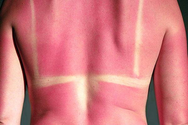 How Can I Stay Safe in the Sun this Summer?