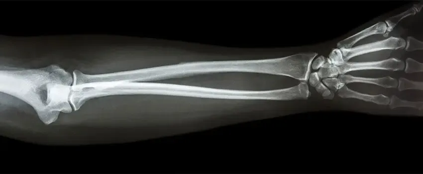 When Should My Child Get an X-ray?