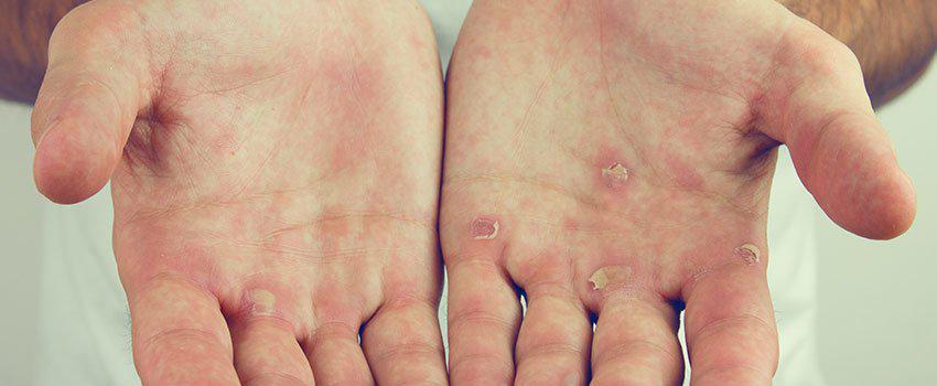 How Can I Keep My Skin Healthy When It Gets Cold Outside?