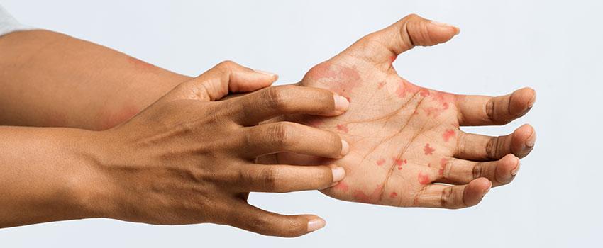 Is It Possible to Get Rid of Eczema?- AFC Urgent Care