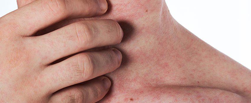 How to Treat a Skin Rash How to Treat a Skin Rash