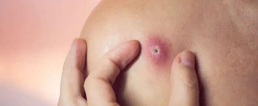 What You Need to Know About Boils What You Need to Know About Boils