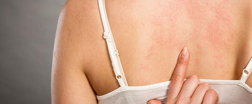 How Can I Treat an Eczema Rash?