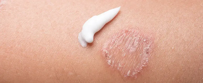 Is Ringworm Serious?
