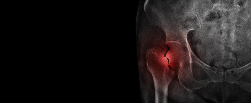 Can a Small Fracture Get Worse?