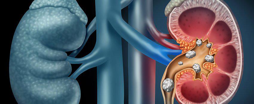 What Symptoms Do Kidney Stones Cause?