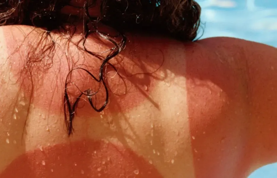 Feeling the (Sun) Burn? | Knoxville, TN Walk-In Clinic