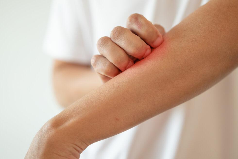 Is This Heat Rash or Poison Ivy? Common Summer Skin Rashes in Allen, TX