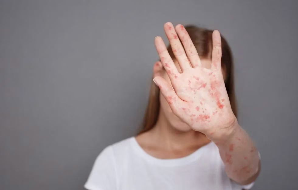 How Contagious is Measles?