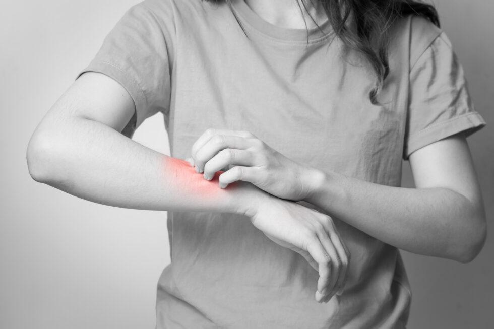 How Does AFC Treat Poison Ivy?